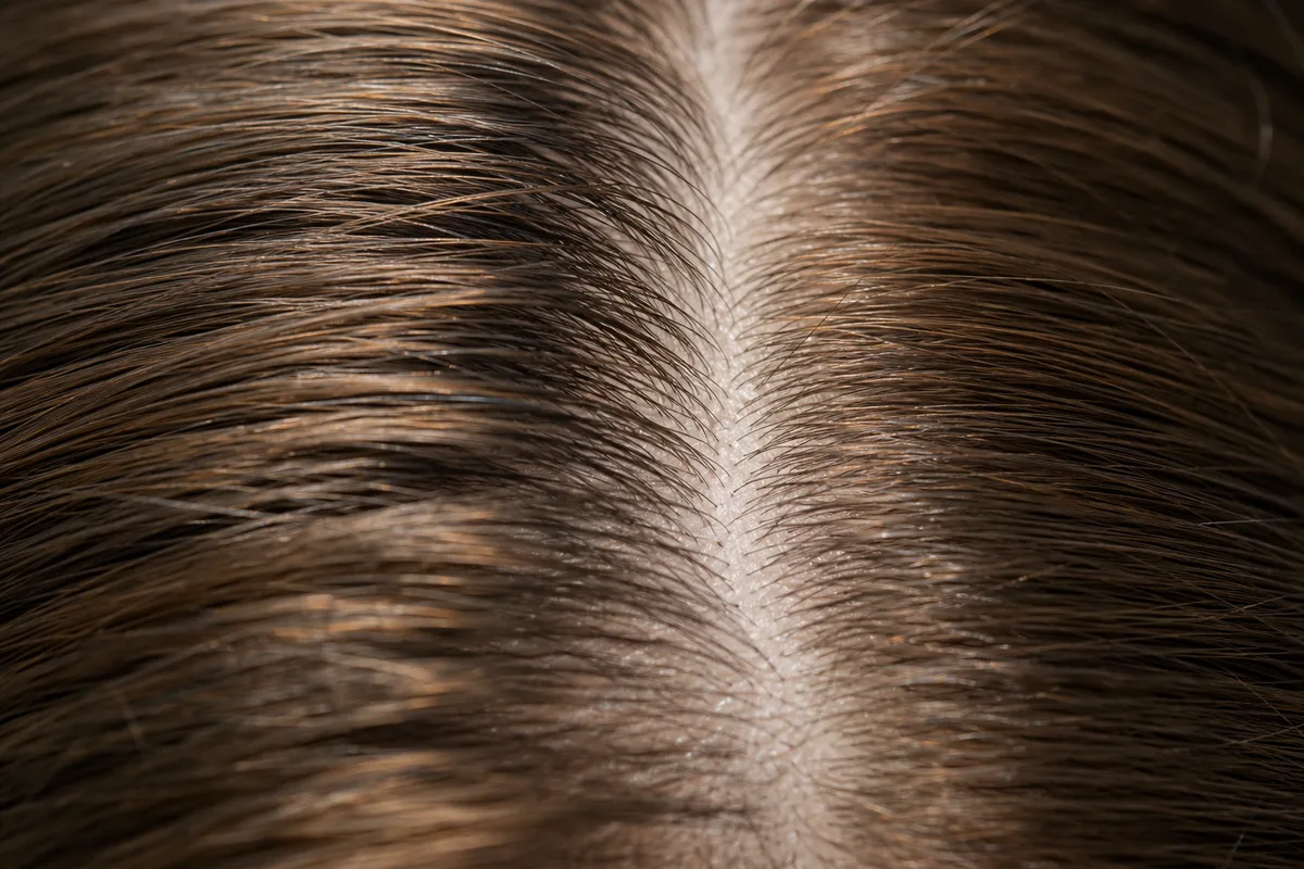 Racines de cheveux en gros plan sur un cuir chevelu, texture de peau visible